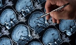 Doğal lityum seviyesi Alzheimer'ın ilerlemesini etkiliyor