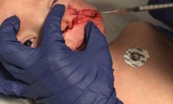 Başkentte 2 kardeş pitbull saldırısına uğradı