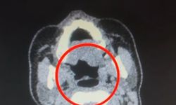 Şüphelinin midesinden metamfetamin çıktı