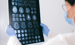 Glioblastoma ve Kemik Aşınması: Tümör Kafatasını Eritebilir mi?