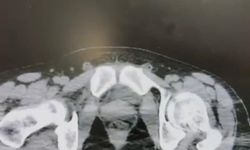 Midelerinde uyuşturucu çıktı