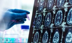 Alzheimer Düşünüldüğünden Daha Erken Başlayabilir
