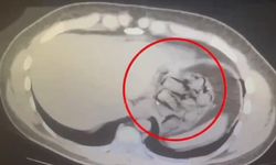 İran uyruklu şüphelinin midesinden uyuşturucu çıktı