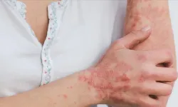 Gıda Alerjisi mi, Gıda Hassasiyeti mi? Arasındaki farklar neler?