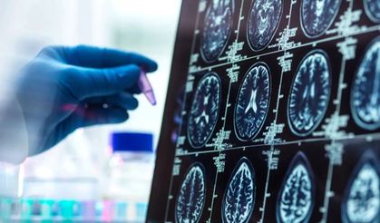 Alzheimer Düşünüldüğünden Daha Erken Başlayabilir