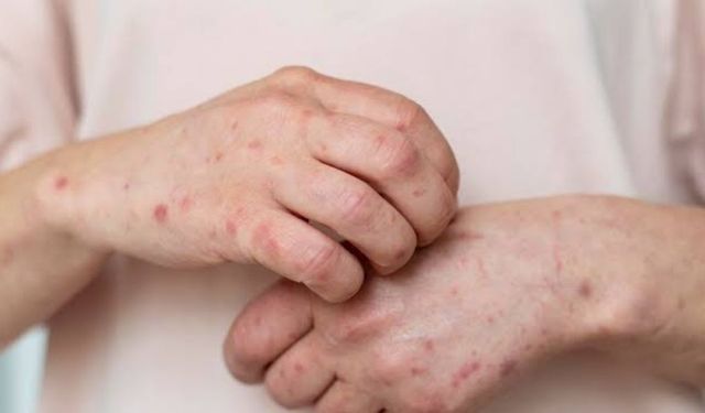 ‘Değişen çevresel koşullar alerjik hastalıkları etkiliyor’