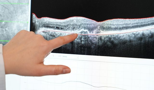 Sarı nokta hastalığı 50 yaş üstünü tehdit ediyor