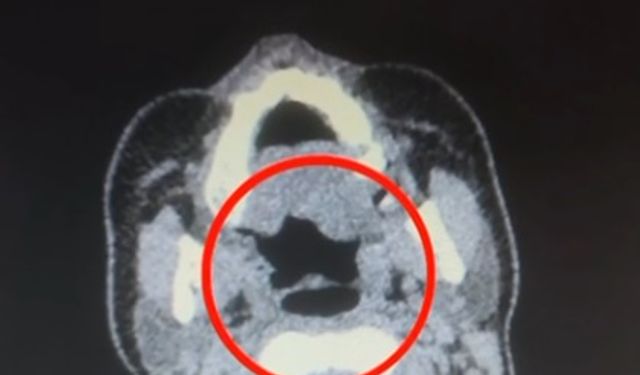 Şüphelinin midesinden metamfetamin çıktı