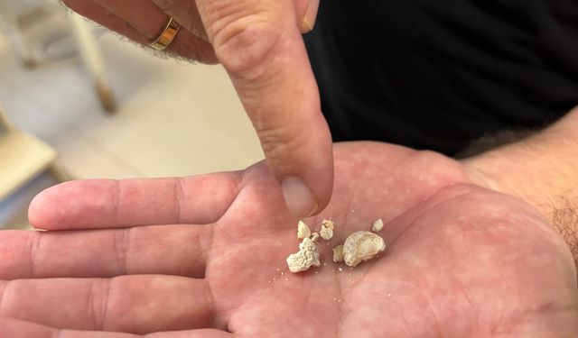 Antalya'da Tükürük Bezi Operasyonu