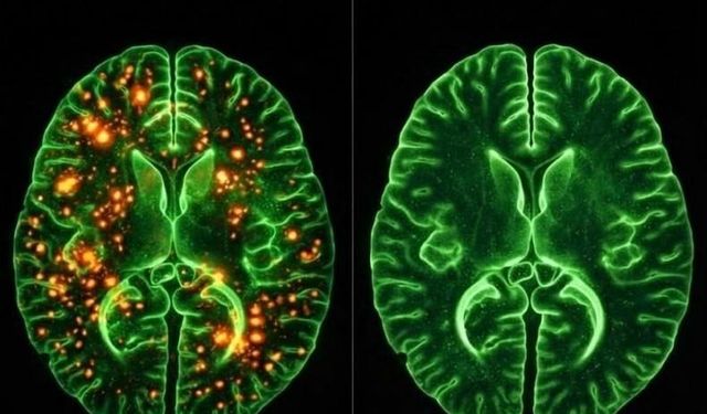 Alzheimer'a Kesin Tedavi Yaklaşıyor
