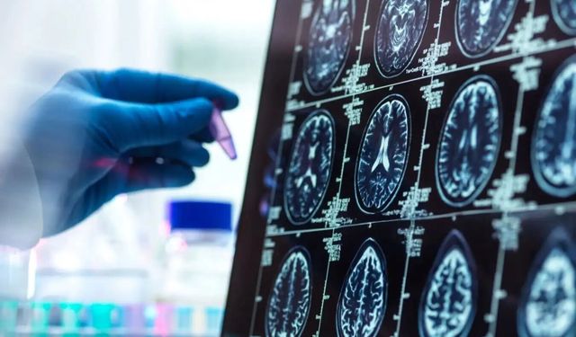 Alzheimer Düşünüldüğünden Daha Erken Başlayabilir