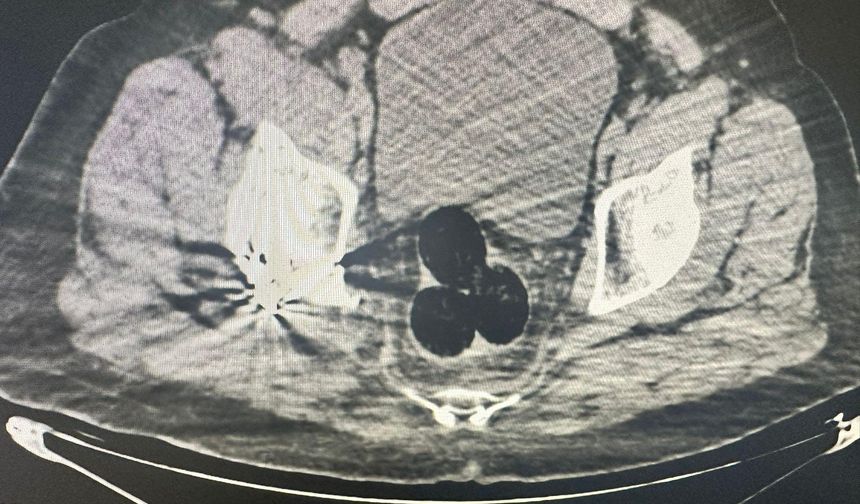 Uyuşturucuyu makatına saklamış