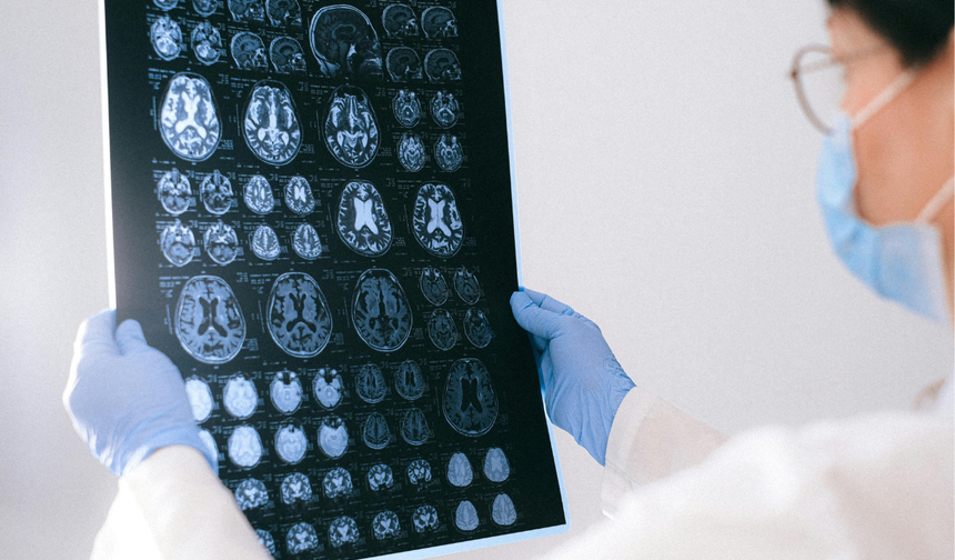 Glioblastoma ve Kemik Aşınması: Tümör Kafatasını Eritebilir mi?